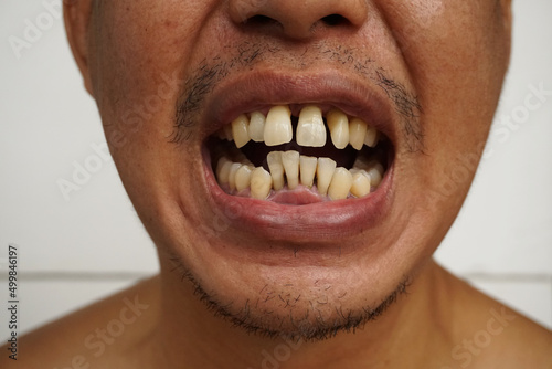 Close up Bad teeth or crooked yellow teeth, Poor dental health, Must visit a dentist to install braces