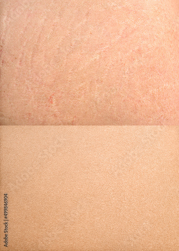 Stretch marks on the skin treatment