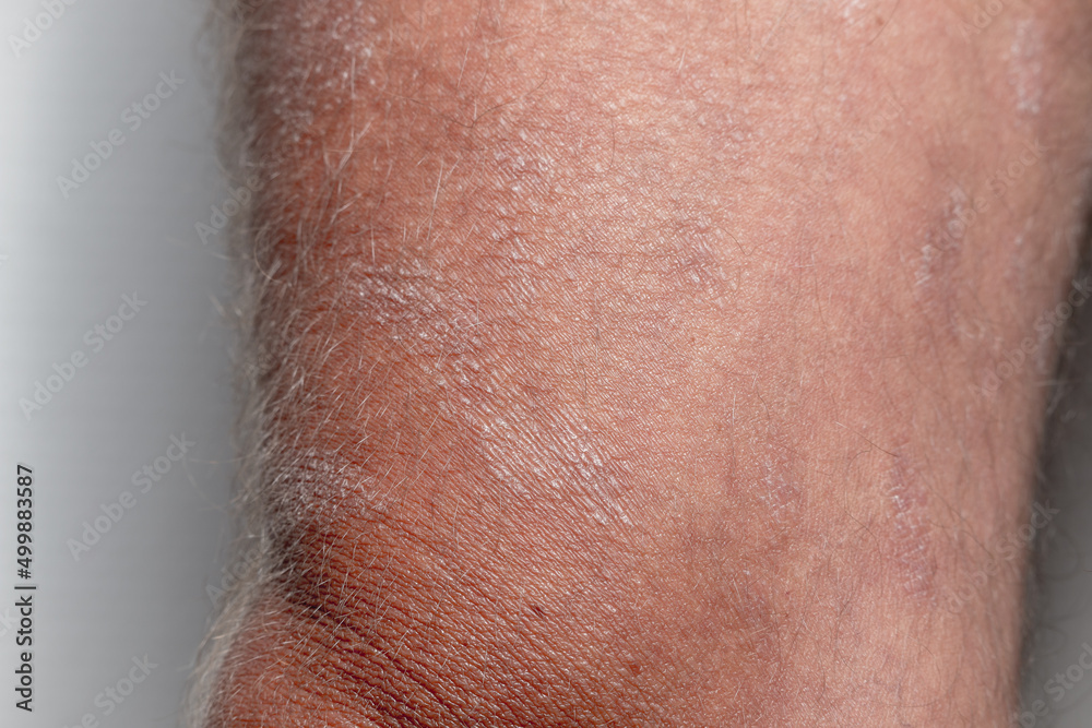 Fototapeta premium Large plaque parapsoriasis on caucasian man legs