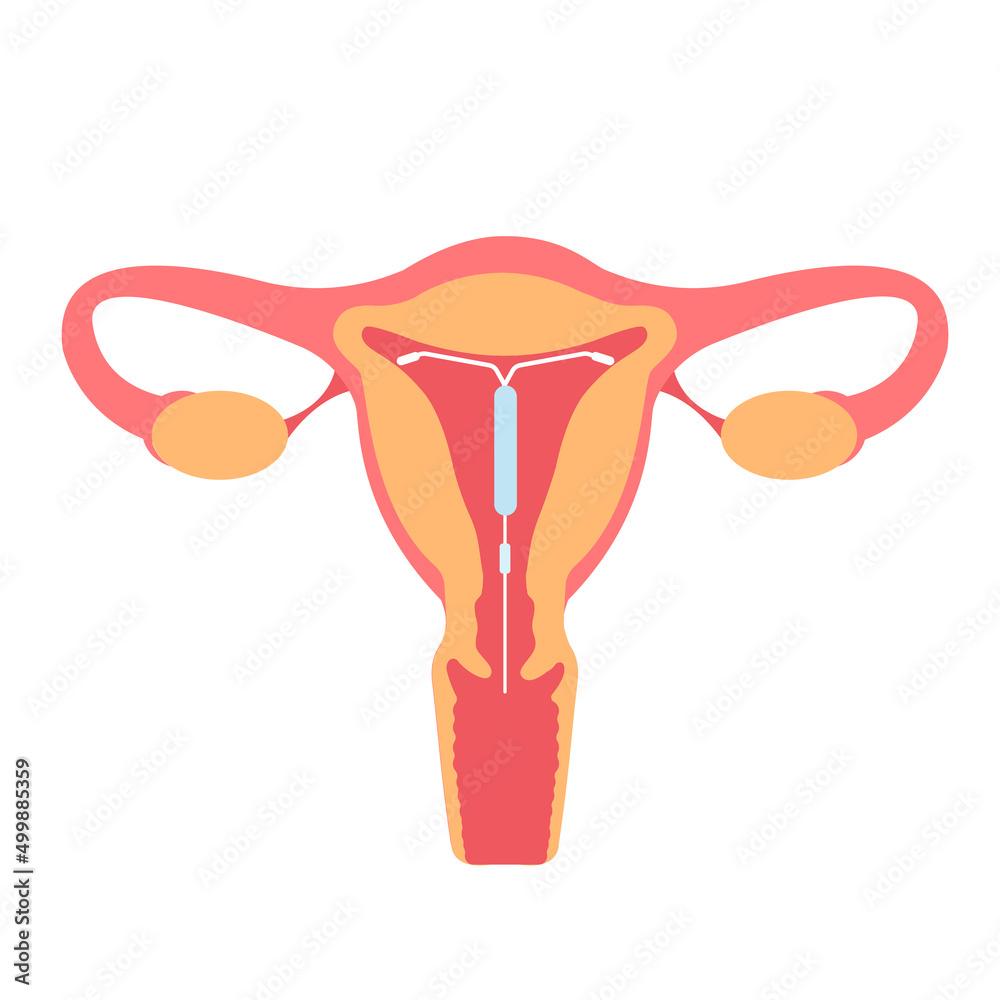 Intrauterine device IUD inside uterus. Female contraception, birth control, reproductive system, spiral. Sex education and responsibility concept
Intrauterine device IUD inside uterus. Female contraception, birth control, reproductive system, spiral. Sex education and responsibility concept