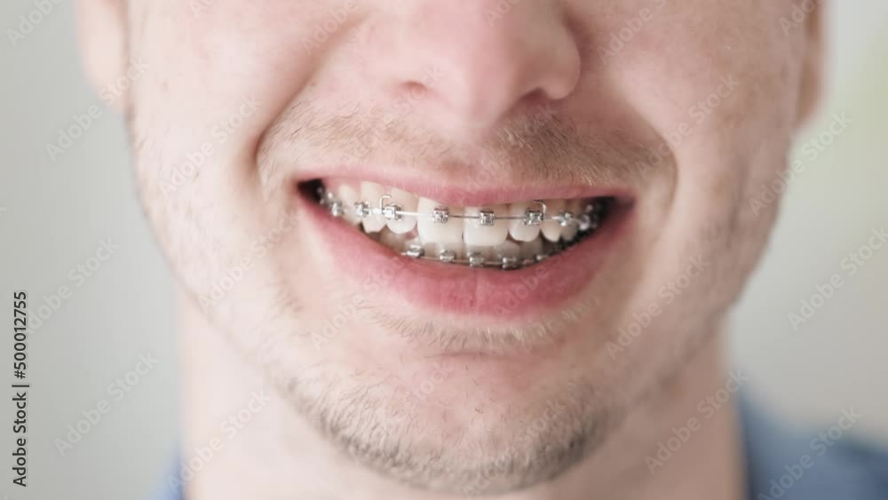 Smile with dental bracket, Man with stubble on the face smiling perfect teeth braces close up, orthodontic, dental care and stomatology, dentistry Smile with dental bracket, Man with stubble on the face smiling perfect teeth braces close up, orthodontic, dental care and stomatology, dentistry