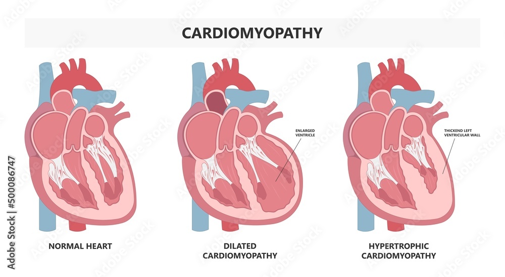 Cardiomyopathy Heart attack artery hypertrophy chamber stress stiff