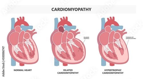 Cardiomyopathy Heart attack artery hypertrophy chamber stress stiff stretched high blood pressure valve right and left edema chest pain lupus immune system disorder arrest photo