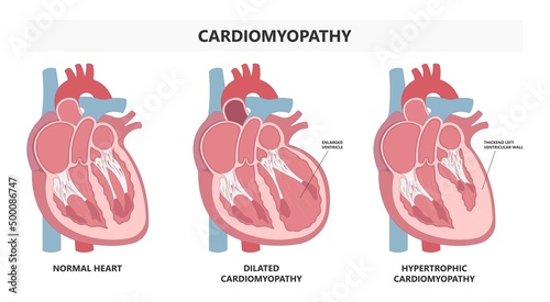 Cardiomyopathy Heart attack artery hypertrophy chamber stress stiff stretched high blood pressure valve right and left edema chest pain lupus immune system disorder arrest