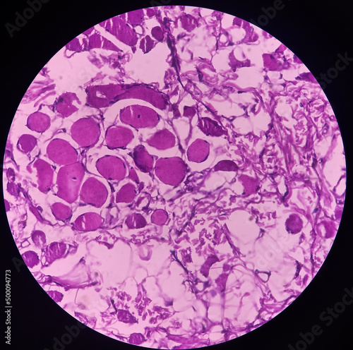 Micrograph of verrucae or chin skin wart, microscopic show epidermal hyperplasia with hyperkeratosis and papillomatosis. dense infiltration of polymorphs, lymphocytes, histiocytes. photo