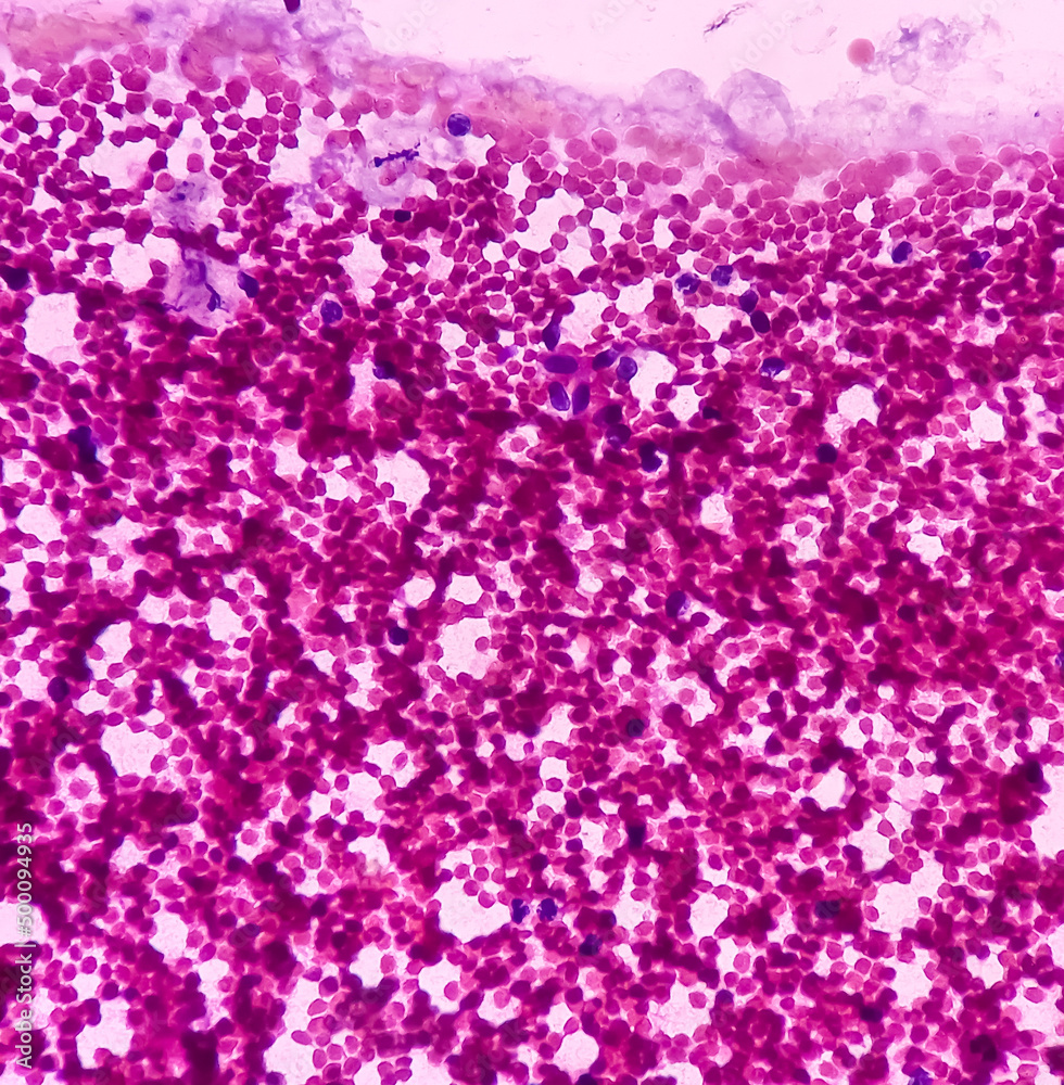 Gynacomastia, microphotograph of male breast lump show benign ductal epithelial cells and fibrous tissue.