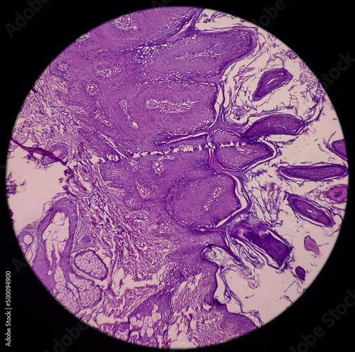 Micrograph of verrucae or chin skin wart, microscopic show epidermal hyperplasia with hyperkeratosis and papillomatosis. dense infiltration of polymorphs, lymphocytes, histiocytes. photo