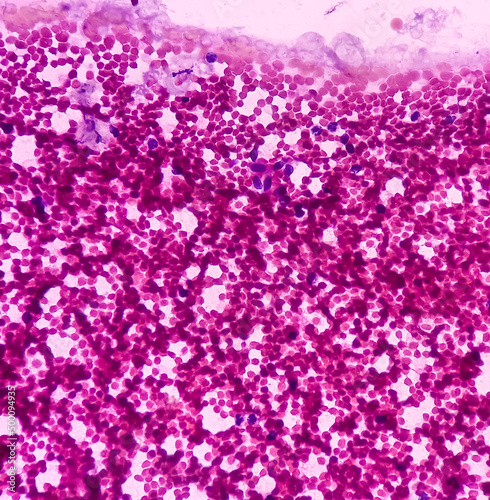 Fototapeta Naklejka Na Ścianę i Meble -  Gynacomastia, microphotograph of male breast lump show benign ductal epithelial cells and fibrous tissue.