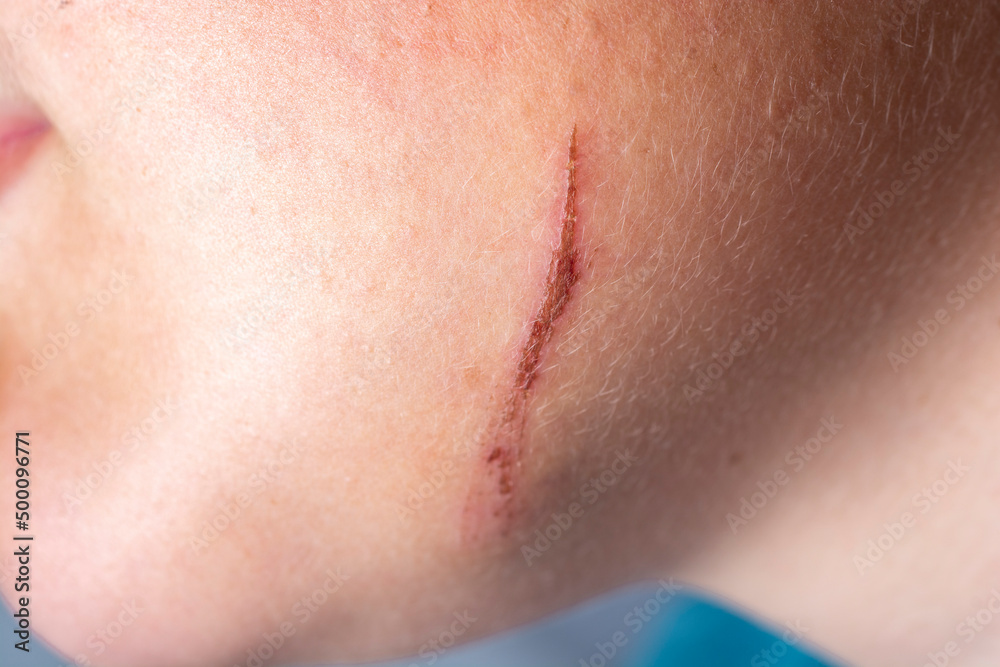 Wound on the chin close-up. Wound on the chin close-up.