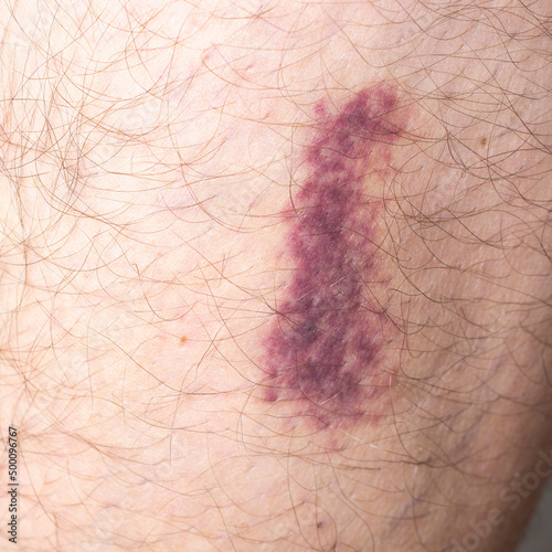 Bruise on leg close up.