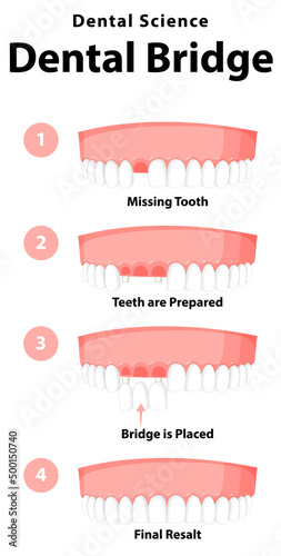 Infographic of human in dental bridge on white background