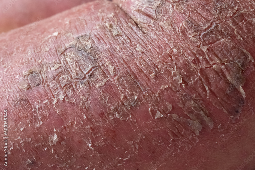 Fototapeta premium Closeup of cracked and dry skin disease. Medical healthcare concept. Cosmetology dermatology concept.