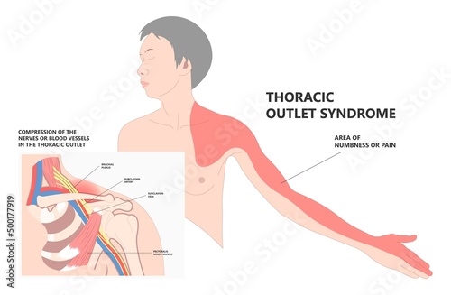 Lifting heavy objects trauma of pinched vagus nerve rib bone neck arm hand pain carpal tunnel outlet minor T4 poor artery blood clots Adson's test