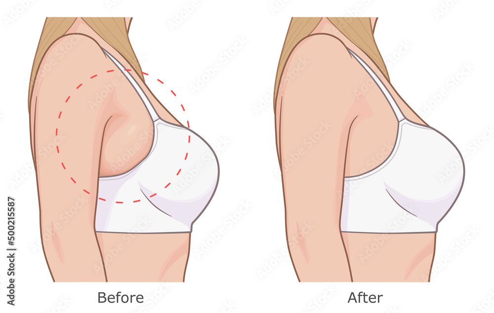 Reduce bra bulge illustration. Woman armpit fat loss vector illustration.  Before and after. Stock Vector