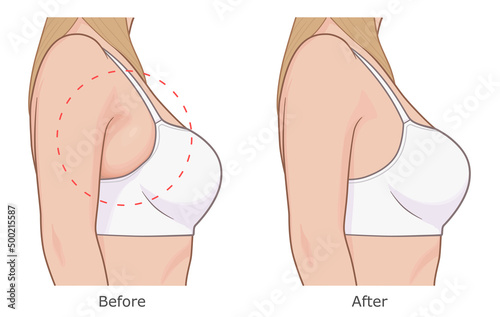 Reduce bra bulge illustration. Woman armpit fat loss vector illustration. Before and after.