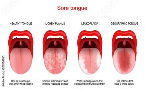 Sore or white tongue. comparison of healthy tongue and oral disease