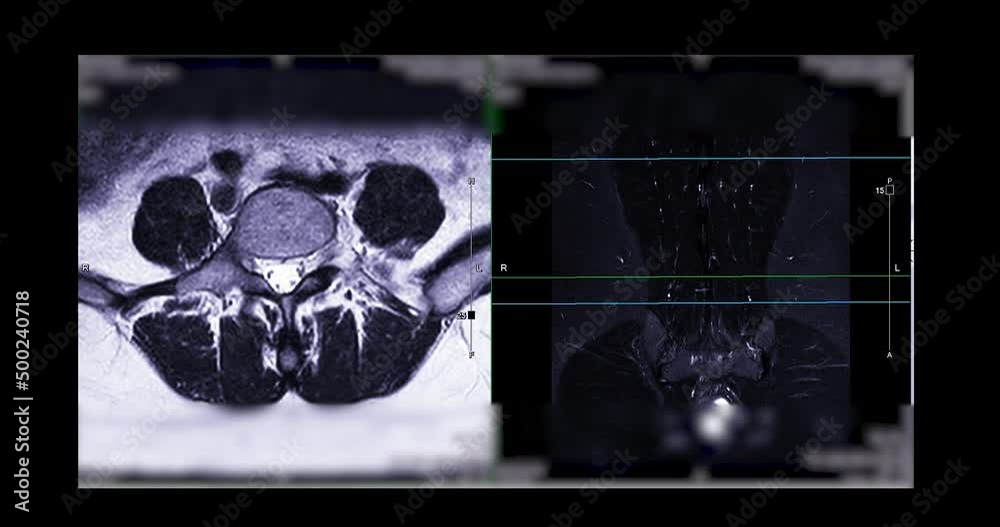 MRI L-S spine or lumbar spine Axial T2W view with sagittal plane for ...