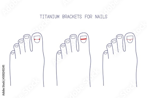 Treatment of ingrown toenail with titanium brackets different types. Hand drawn vector illustration