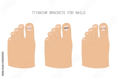 Treatment of ingrown toenail with titanium brackets different types. Hand drawn vector illustration photo