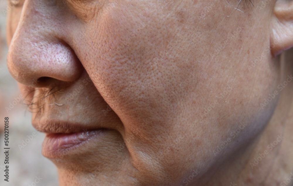 Enlarged pores in face of Asian, elder man with skin folds.