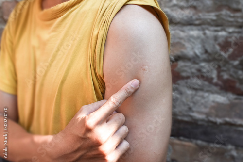 Fotografia BCG or TB vaccine scar mark at the arm of Asian man.