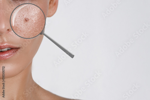 Nevus or pigment spot close-up on the skin of a female, white background