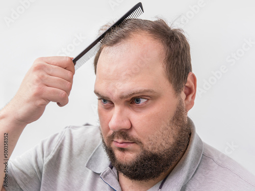 man with a beard combs his hair in front of a mirror. A large bald spot on the forehead. The problem of hair loss. Scalp care concept photo