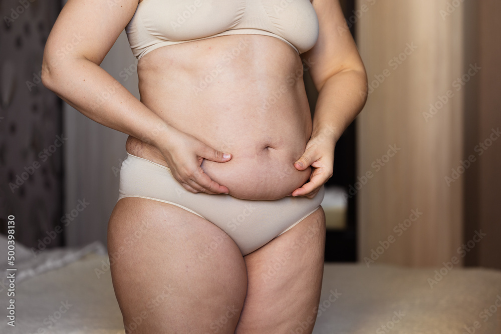 Cropped image of overweight obese woman, hiding fat naked big excessive abdomen with navel in underwear. Dangling down tummy. Drag away of abdomen. Planning liposuction surgery, cellulite problem  - obrazy, fototapety, plakaty 