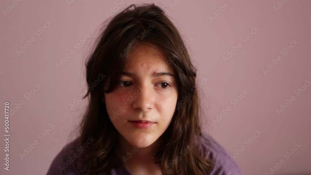 Video of an apathetic and desmotic adolescent, a girl with acne, in her room rests her head on her hand in a gesture of tiredness Video of an apathetic and desmotic adolescent, a girl with acne, in her room rests her head on her hand in a gesture of tiredness