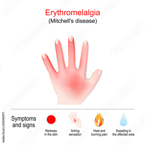 Erythromelalgia. Mitchell's disease in left hand. Symptoms and signs of Erythromelalgia.