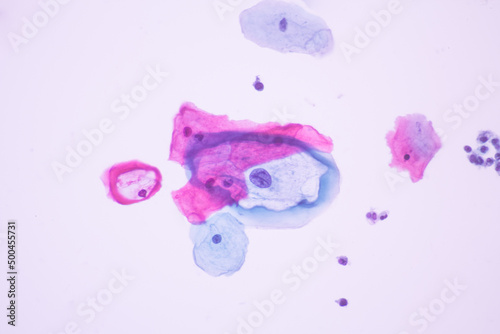 Abnormal squamous epithelial cells view in microscopy.HPV criteria for pap smear slide cytology.Koilocyte cells.Human cell medical concept background. photo