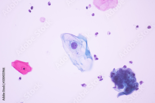 Fototapeta Naklejka Na Ścianę i Meble -  Abnormal squamous epithelial cells view in microscopy.HPV criteria for pap smear slide cytology.Koilocyte cells.Human cell medical concept background.