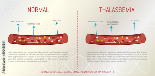 Infographic of normal and thalassemia genetic disease red blood cells. photo
