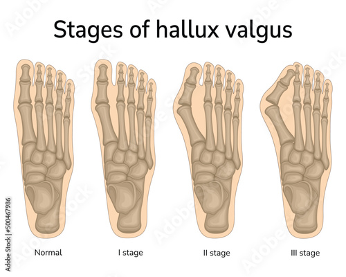 Three stages of valgus deformity of the big toe