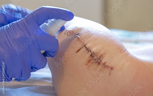 Postoperative dressing, the hands of a doctor in blue gloves, a nurse or a doctor who treats the patient's wound after surgery and disinfects with antibacterial spray to clean the wound after suturing