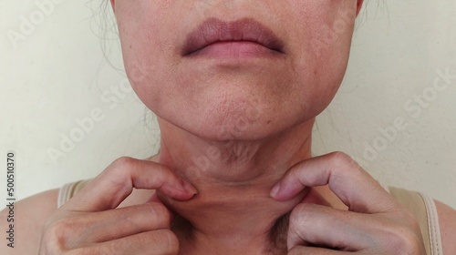 Portrait showing the fingers squeezing flabbiness adipose skin under the neck  problem cellulite and sagging skin under the chin  concept health care.