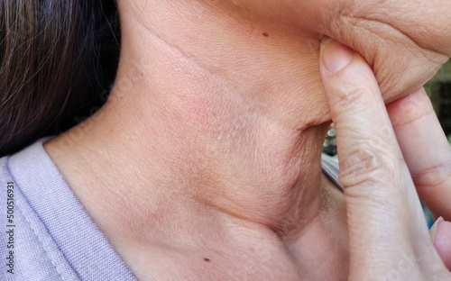 Portrait showing the fingers squeezing flabbiness adipose hanging under the neck, problem cellulite and double chin, mole on the body of the woman, concept health care.