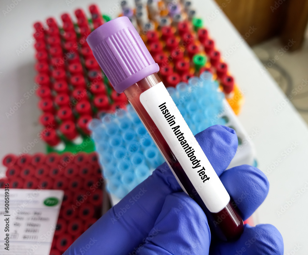 Blood sample for Insulin autoantibody test, Autoantibodies Against