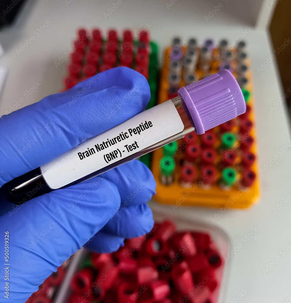 Foto de Blood sample for BNP(Brain natriuretic peptide) test, NTproBNP Foto de Blood sample for BNP(Brain natriuretic peptide) test, NTproBNP
