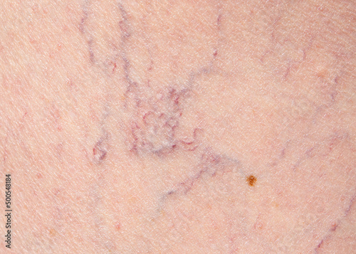 Vascular diseases. Varicose veins. Varicose veins of small vessels on the skin of a woman's thigh.Leg skin repair and treatment concept for elderly and aged people. 