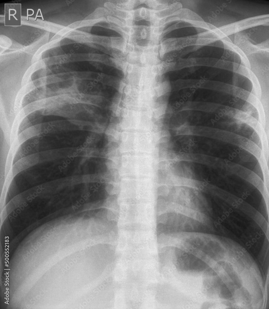 chest xray image of lung abscess Stock Photo Adobe Stock
