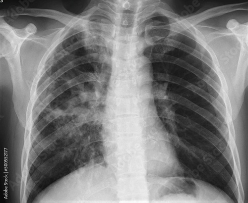 chest x-ray image of  lung abscess photo
