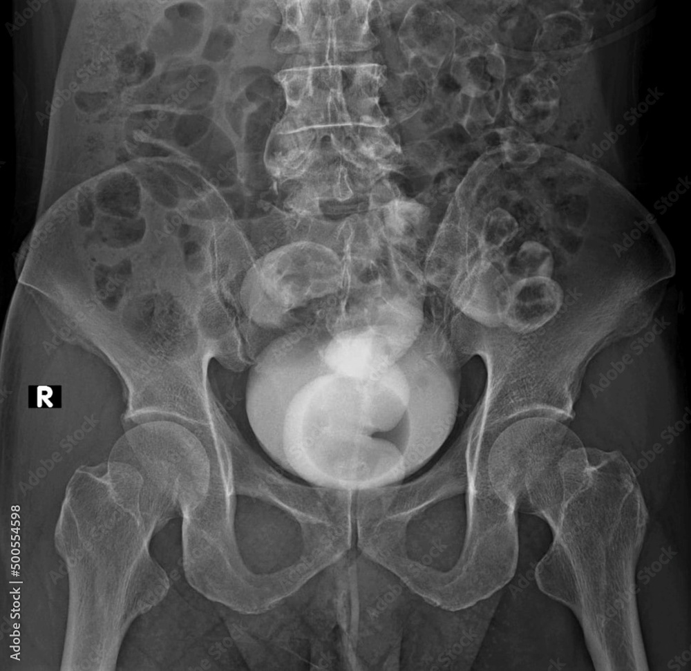 Xray image of rectovesical fistula A barium enema contrast study reveals contrasts on the