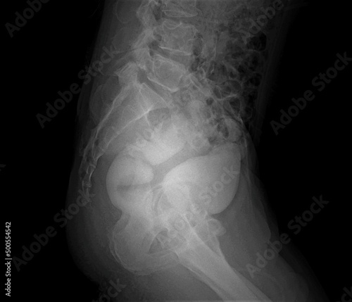 X-ray image of rectovesical fistula A barium enema contrast study reveals contrasts on the rectum and bladder.