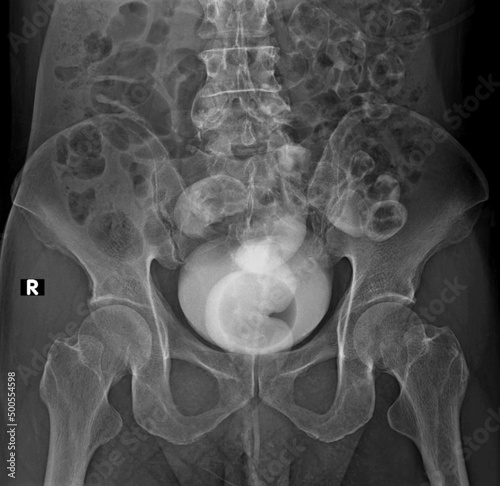 Slika na platnu X-ray image of rectovesical fistula A barium enema contrast study reveals contrasts on the rectum and bladder