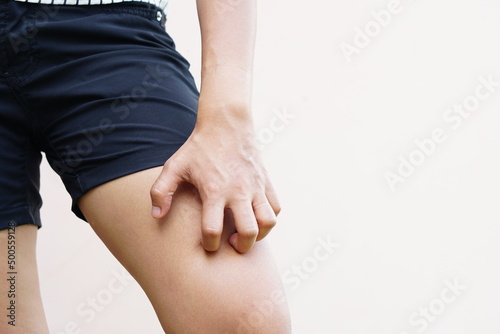 Woman wearing shorts itchy legs Scratch with your hands to relieve itching. 