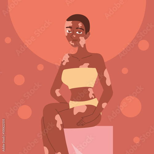 young woman with vitiligo pigmentation