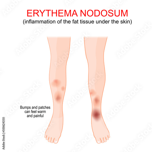 Erythema nodosum. inflammation of the fat tissue under the skin. photo