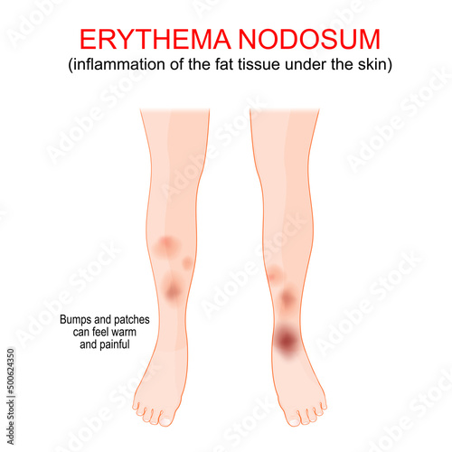 Erythema nodosum. inflammation of the fat tissue under the skin.