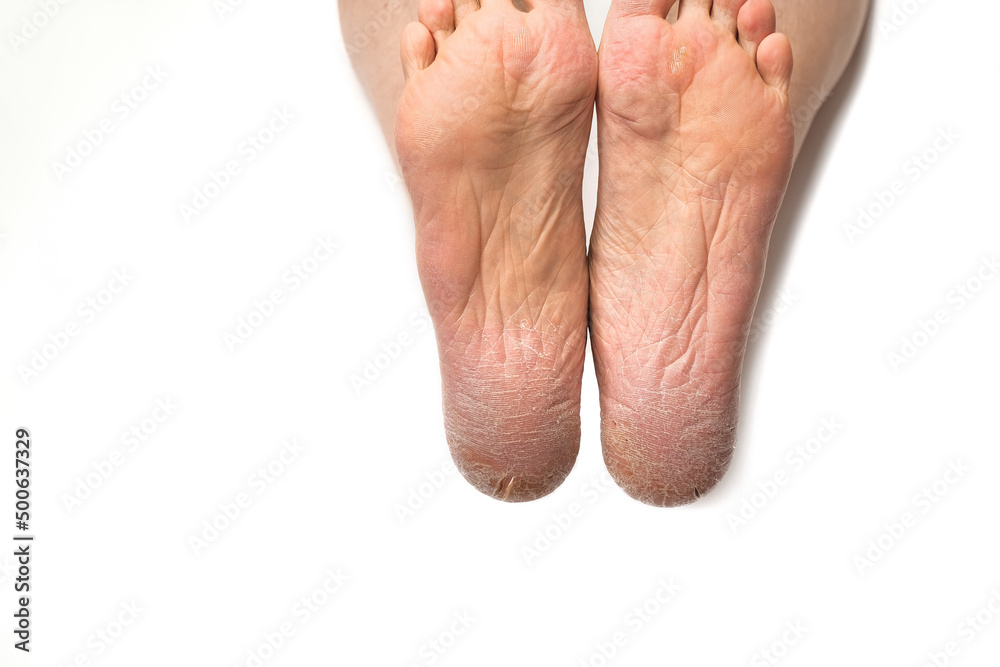 Dry cracked skin of man feet and heels isolated on white. Dry cracked skin of man feet and heels isolated on white.